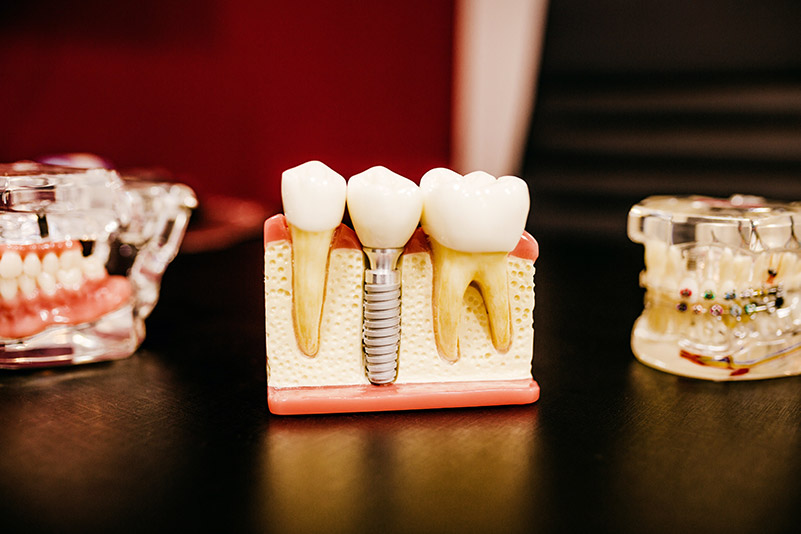 Implant zębowy czyli sztuczny ząb ze śrubą zamontowany w sztuczną szczękę